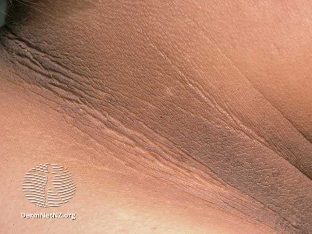 Acantose nigricans no diabetes mellitus