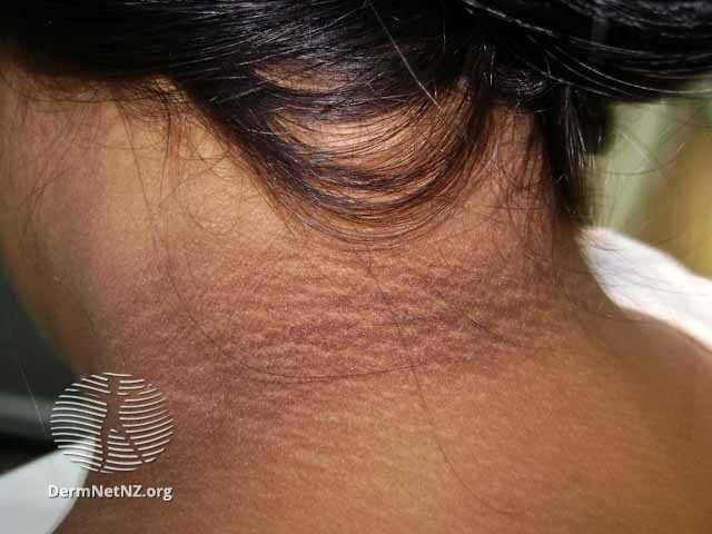 Acantose nigricans no diabetes mellitus